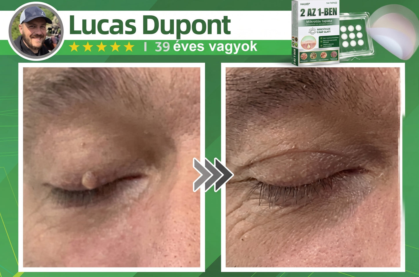 🇭🇺 HAJUEI® ☺️ 2-az-1-ben Mikrotű & Hidrokoloid Tapasz | 🧪 Kiemelkedő Anyajegyek, Pattanások, Lapos Szemölcsök & Bőrkinövések Eltávolítója | Ráncok, Hegek & Bőrhibák Javítása | Láthatatlan Csillag Pattanástapasz Arcra & Testre | 144 db ✨