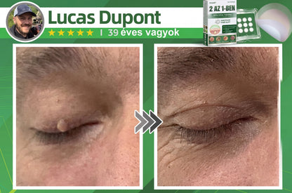 🇭🇺 HAJUEI® ☺️ 2-az-1-ben Mikrotű & Hidrokoloid Tapasz | 🧪 Kiemelkedő Anyajegyek, Pattanások, Lapos Szemölcsök & Bőrkinövések Eltávolítója | Ráncok, Hegek & Bőrhibák Javítása | Láthatatlan Csillag Pattanástapasz Arcra & Testre | 144 db ✨