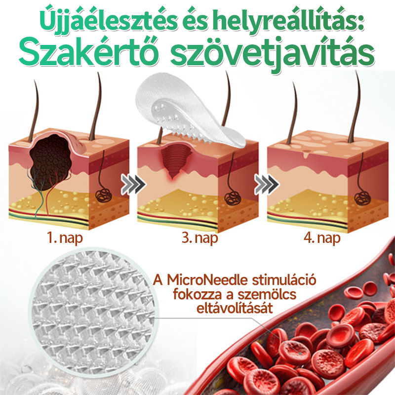 🇭🇺 HAJUEI® ☺️ 2-az-1-ben Mikrotű & Hidrokoloid Tapasz | 🧪 Kiemelkedő Anyajegyek, Pattanások, Lapos Szemölcsök & Bőrkinövések Eltávolítója | Ráncok, Hegek & Bőrhibák Javítása | Láthatatlan Csillag Pattanástapasz Arcra & Testre | 144 db ✨