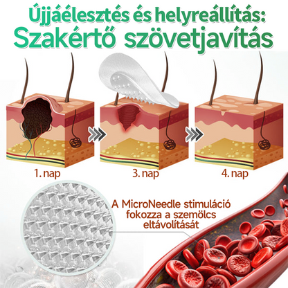 🇭🇺 HAJUEI® ☺️ 2-az-1-ben Mikrotű & Hidrokoloid Tapasz | 🧪 Kiemelkedő Anyajegyek, Pattanások, Lapos Szemölcsök & Bőrkinövések Eltávolítója | Ráncok, Hegek & Bőrhibák Javítása | Láthatatlan Csillag Pattanástapasz Arcra & Testre | 144 db ✨