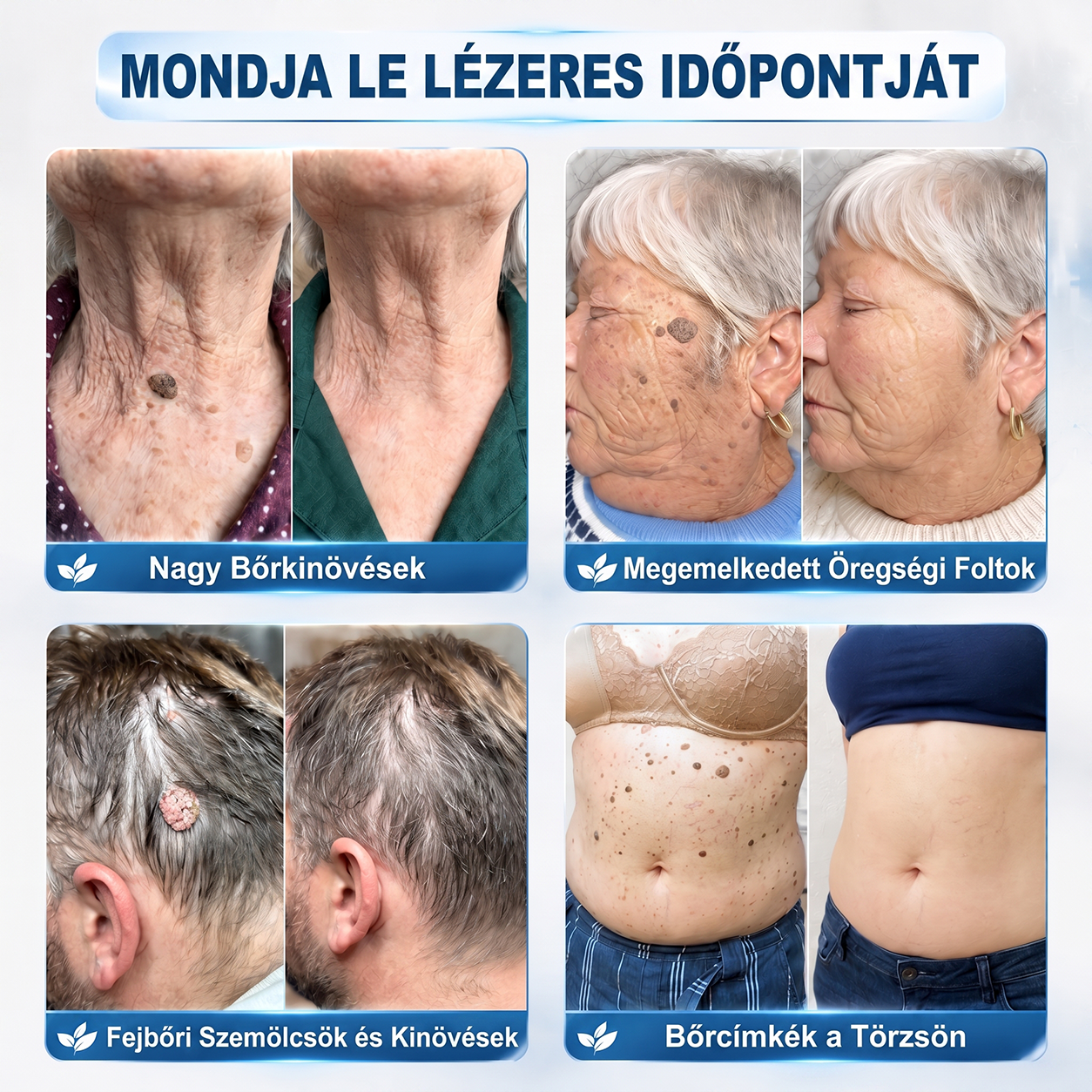 Hivatalos Márkabolt | 🚢🚢 Hiskin® 7 napos Szemölcseltávolító Roll-on Ápoló Folyadék (Fájdalommentes rollerball technológia, hegek nélkül) --🐬