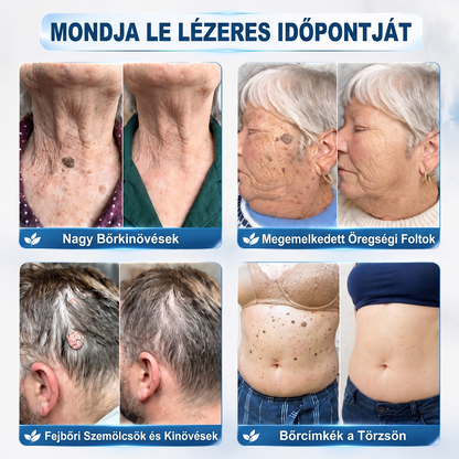 Hivatalos Márkabolt | 🚢🚢 Hiskin® 7 napos Szemölcseltávolító Roll-on Ápoló Folyadék (Fájdalommentes rollerball technológia, hegek nélkül) --🐬