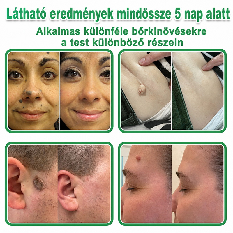 🇭🇺 HAJUEI® ☺️ 2-az-1-ben Mikrotű & Hidrokoloid Tapasz | 🧪 Kiemelkedő Anyajegyek, Pattanások, Lapos Szemölcsök & Bőrkinövések Eltávolítója | Ráncok, Hegek & Bőrhibák Javítása | Láthatatlan Csillag Pattanástapasz Arcra & Testre | 144 db ✨