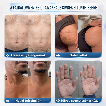 Hivatalos Márkabolt | 🚢🚢 Hiskin® 7 napos Szemölcseltávolító Roll-on Ápoló Folyadék (Fájdalommentes rollerball technológia, hegek nélkül) --🐬