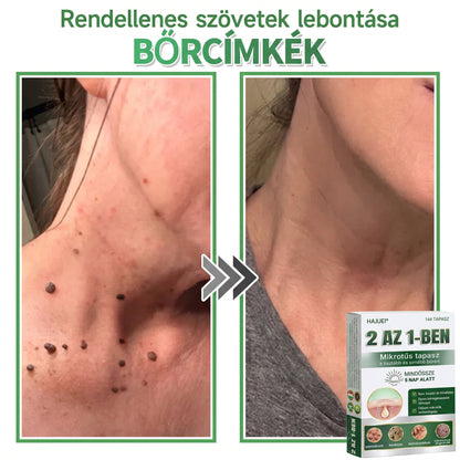 🇭🇺 HAJUEI® ☺️ 2-az-1-ben Mikrotű & Hidrokoloid Tapasz | 🧪 Kiemelkedő Anyajegyek, Pattanások, Lapos Szemölcsök & Bőrkinövések Eltávolítója | Ráncok, Hegek & Bőrhibák Javítása | Láthatatlan Csillag Pattanástapasz Arcra & Testre | 144 db ✨