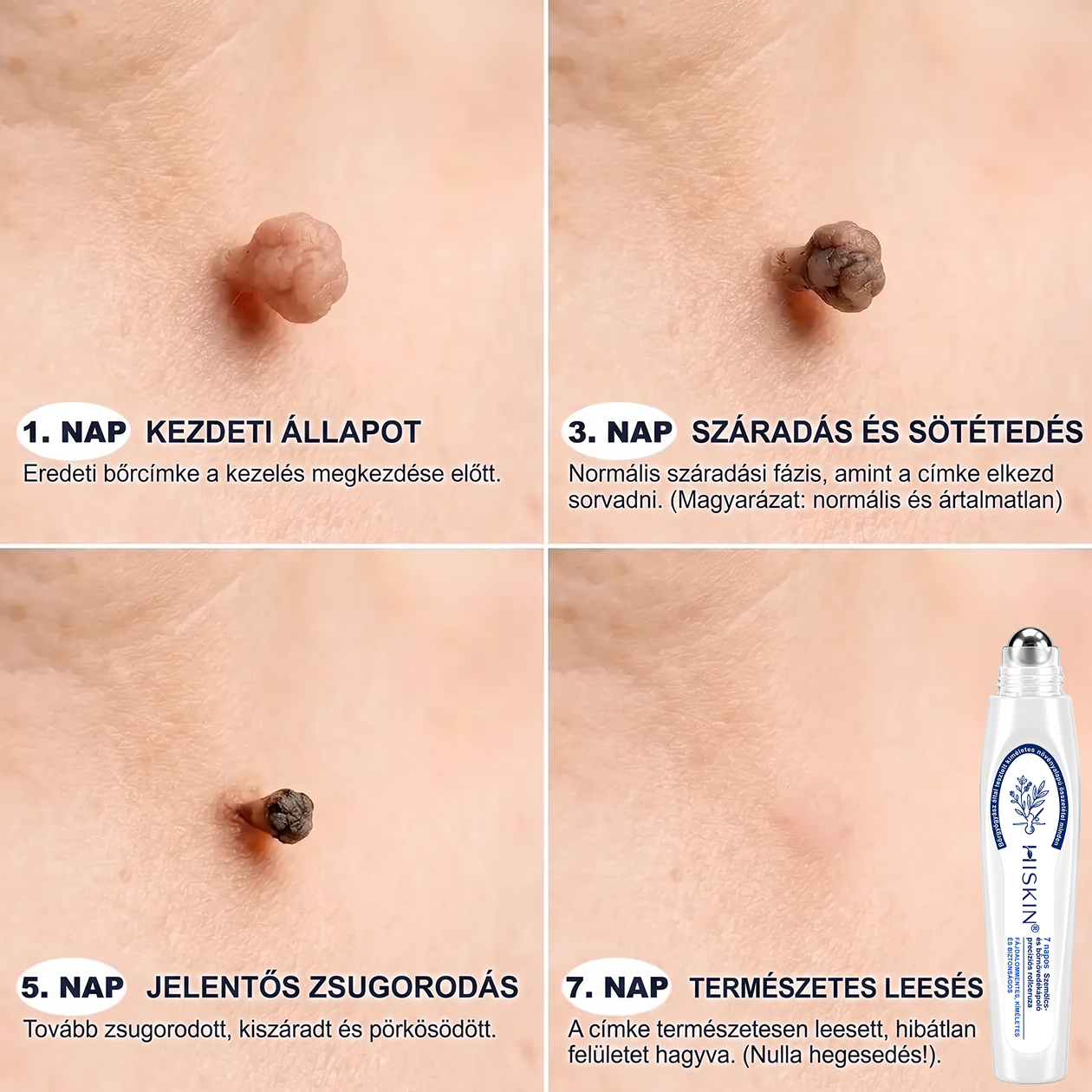 Hivatalos Márkabolt | 🚢🚢 Hiskin® 7 napos Szemölcseltávolító Roll-on Ápoló Folyadék (Fájdalommentes rollerball technológia, hegek nélkül) --🐬