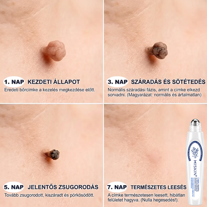 Hivatalos Márkabolt | 🚢🚢 Hiskin® 7 napos Szemölcseltávolító Roll-on Ápoló Folyadék (Fájdalommentes rollerball technológia, hegek nélkül) --🐬