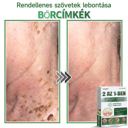 🇭🇺 HAJUEI® ☺️ 2-az-1-ben Mikrotű & Hidrokoloid Tapasz | 🧪 Kiemelkedő Anyajegyek, Pattanások, Lapos Szemölcsök & Bőrkinövések Eltávolítója | Ráncok, Hegek & Bőrhibák Javítása | Láthatatlan Csillag Pattanástapasz Arcra & Testre | 144 db ✨