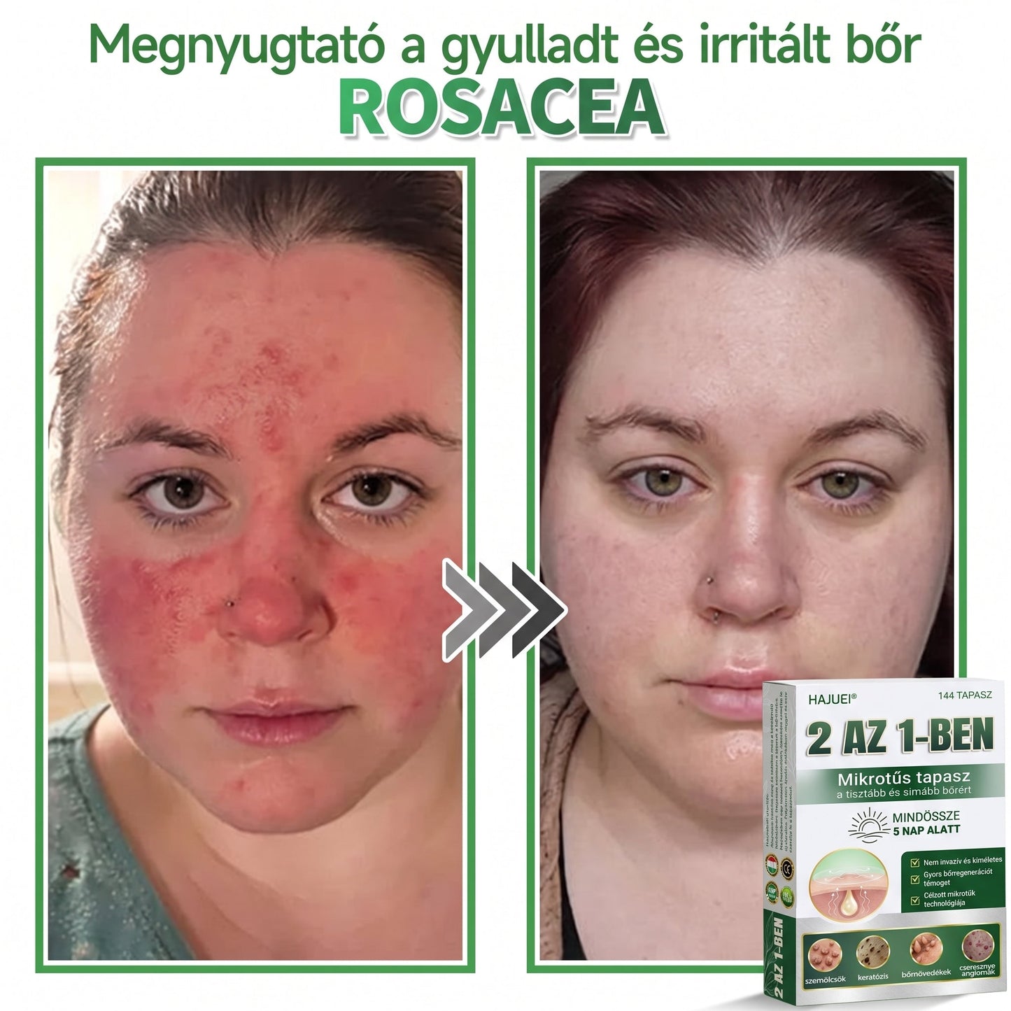 🇭🇺 HAJUEI® ☺️ 2-az-1-ben Mikrotű & Hidrokoloid Tapasz | 🧪 Kiemelkedő Anyajegyek, Pattanások, Lapos Szemölcsök & Bőrkinövések Eltávolítója | Ráncok, Hegek & Bőrhibák Javítása | Láthatatlan Csillag Pattanástapasz Arcra & Testre | 144 db ✨