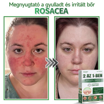 🇭🇺 HAJUEI® ☺️ 2-az-1-ben Mikrotű & Hidrokoloid Tapasz | 🧪 Kiemelkedő Anyajegyek, Pattanások, Lapos Szemölcsök & Bőrkinövések Eltávolítója | Ráncok, Hegek & Bőrhibák Javítása | Láthatatlan Csillag Pattanástapasz Arcra & Testre | 144 db ✨