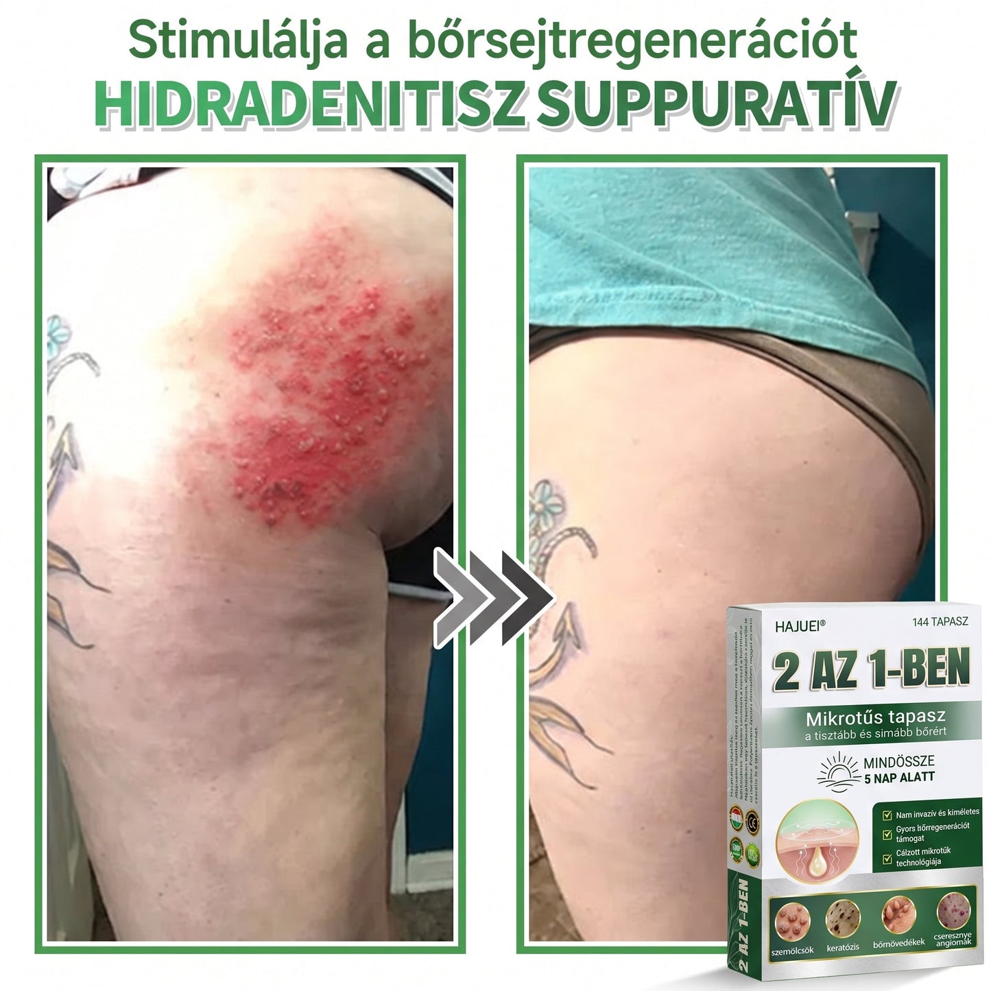 🇭🇺 HAJUEI® ☺️ 2-az-1-ben Mikrotű & Hidrokoloid Tapasz | 🧪 Kiemelkedő Anyajegyek, Pattanások, Lapos Szemölcsök & Bőrkinövések Eltávolítója | Ráncok, Hegek & Bőrhibák Javítása | Láthatatlan Csillag Pattanástapasz Arcra & Testre | 144 db ✨